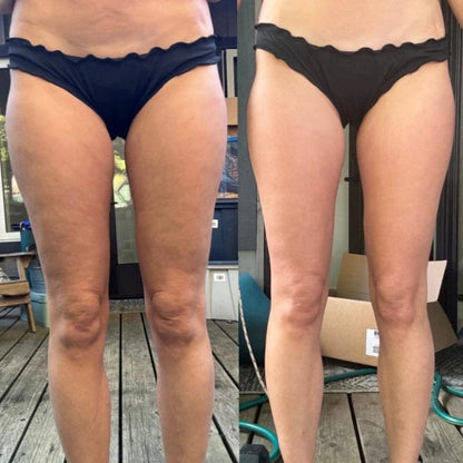 GlowSculpt™ Anti-Cellulite Massager